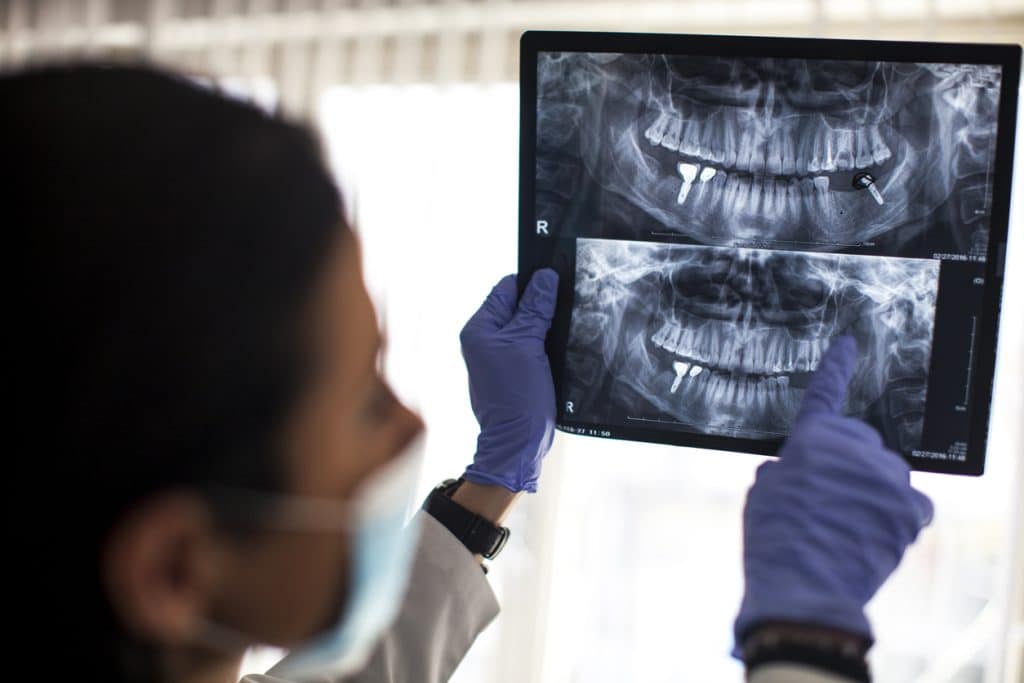Who Is a Good Candidate for Dental Implants